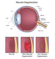 Mobile opticians in Norfolk. Macular degeneration and cataracts.