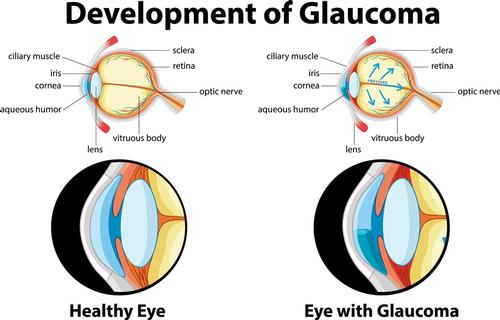 Mobile opticians in Norfolk and Norwich. How glaucoma works.