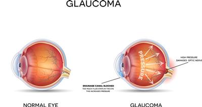 Mobile opticians in Norfolk and Norwich. Glaucoma and eye examination at home.