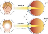 Mobile opticians in Norfolk and Norwich. Macular degeneration and cataracts.